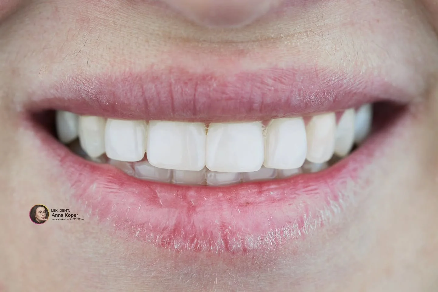 Wypoczęci i pełni zapału wracamy do gabinetu, gotowi na kolejne metamorfozy Waszych uśmiech&oacute;w.
‼️Dlaczego bonding powinien być pierwszym wyborem?
 ✅️ Pełne bezpieczeństwo:To jedna z niewielu metod pozwalająca na zmianę kształtu i koloru zęb&oa