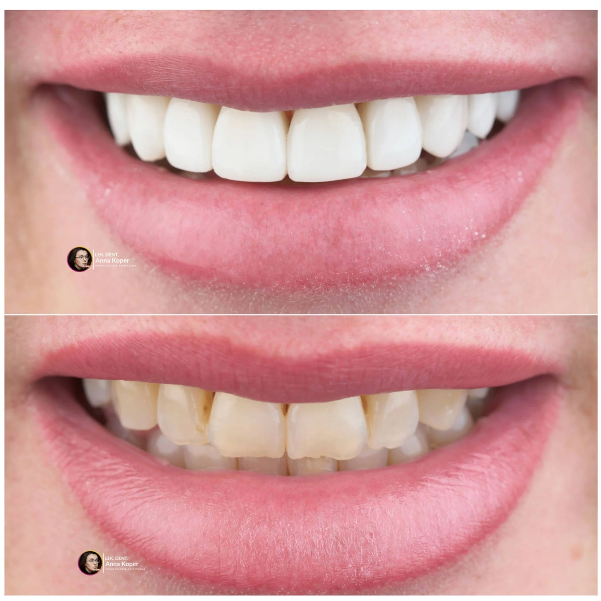 Jedna wizyta. Zero szlifowania. Taki efekt. 🤍

Bonding &mdash; odbudowa startych, przebarwionych zęb&oacute;w bez nieodwracalnej ingerencji.

Konsultacje: 514 243 400

#bonding #estiface #annakoper #siedlce #przedipo