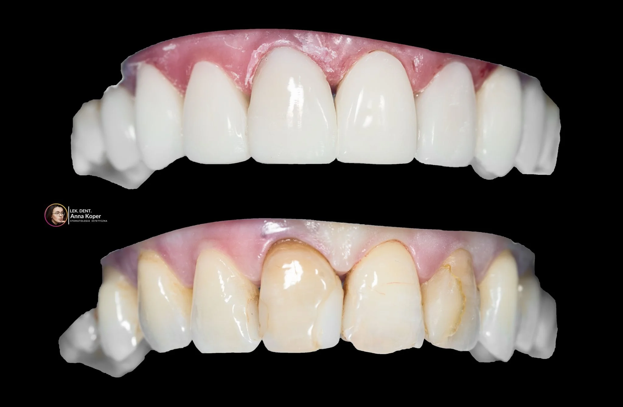 Wiele os&oacute;b patrzy na swoje zęby i myśli &mdash; "to już tak ma być".
Takie przypadki jako praktyk widuję w gabinecie bardzo często.

Stare kompozyty &mdash; każdy w innym odcieniu, bo dokładano je na r&oacute;żnych wizytach przez lat