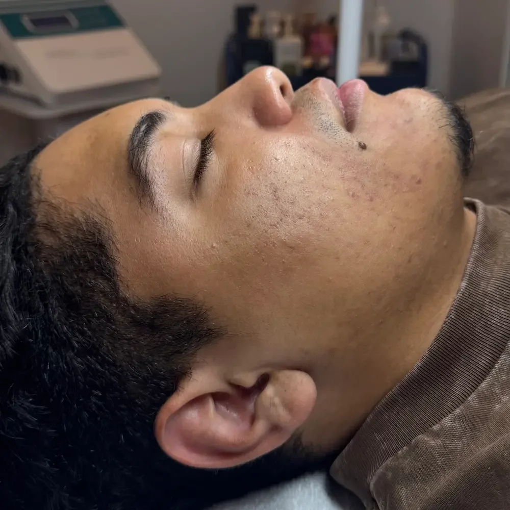 Profile view of a male client showing progress and improvement in acne condition.