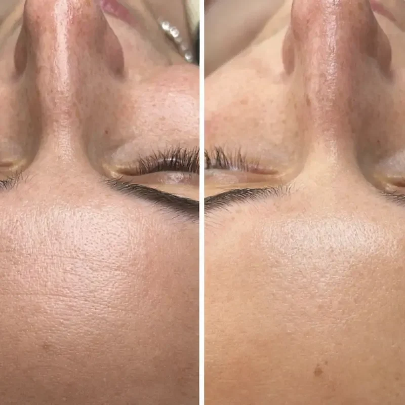 Before and after close-up comparison of forehead and nose skin texture improvement.