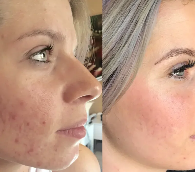 Profile view comparison showing significant reduction in acne scarring before and after treatment.