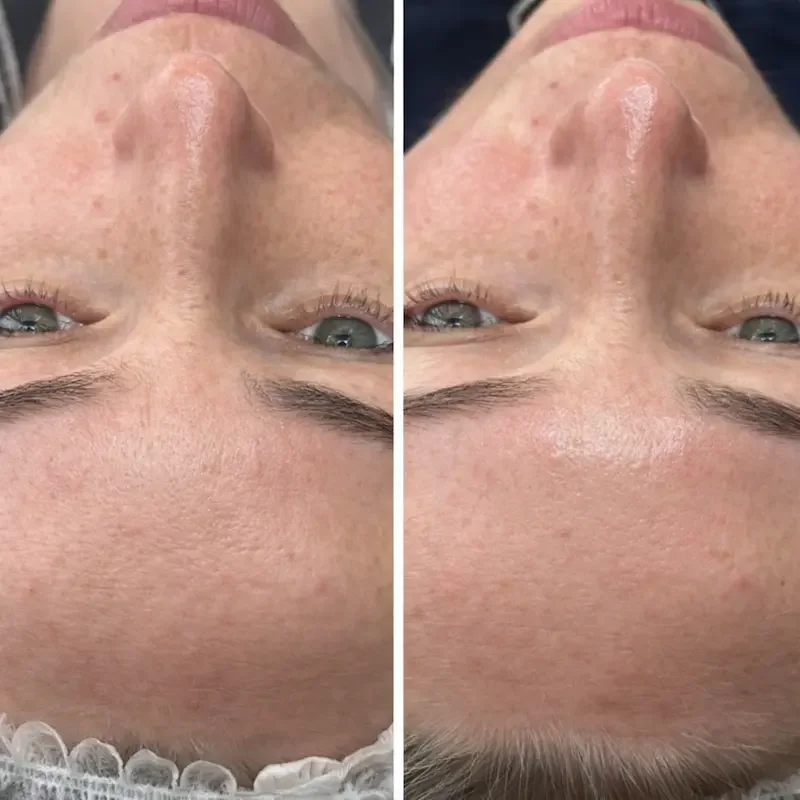 Full face before and after comparison showing visible reduction in redness and improved skin smoothing.
