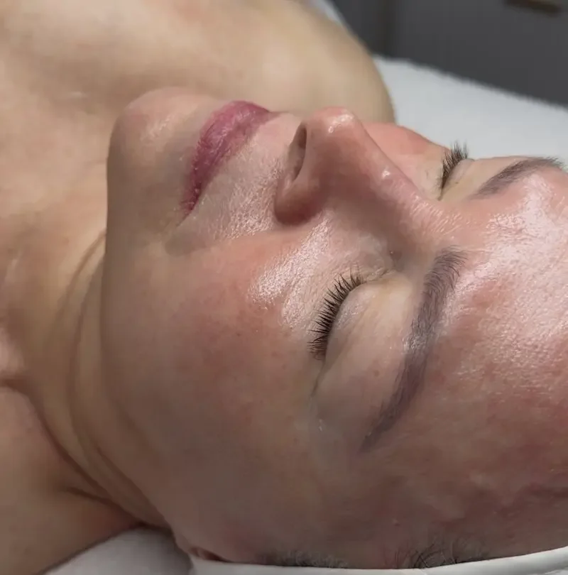 Client profile view showing skin texture and condition during a skincare procedure.