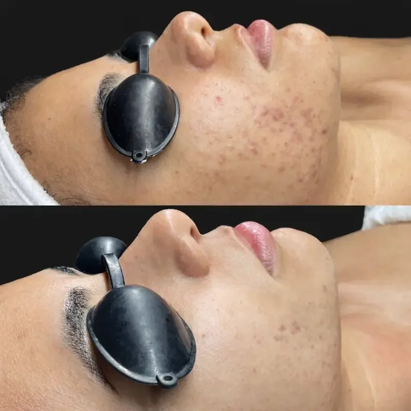 Profile comparison of active acne treatment results with client wearing protective goggles.