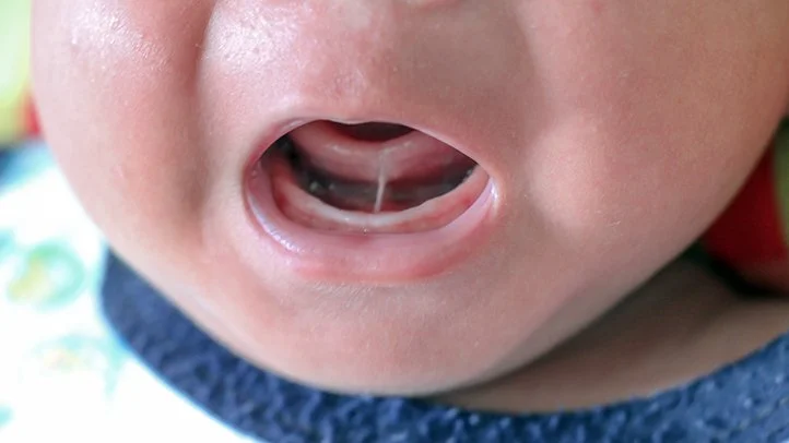 Tongue Tie Signs Most Parents Miss