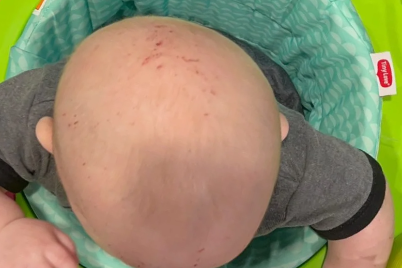 Chiropractic Care for Flat Head Syndrome: Supporting Healthy Head Shape and Development