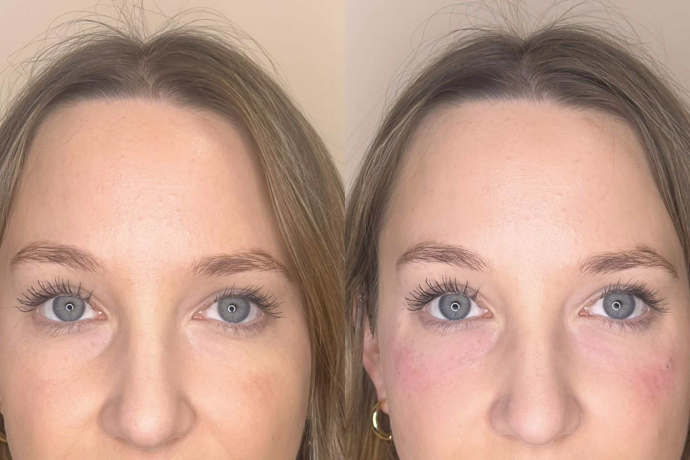 Natural Tear Trough (NTT) approach done at SLB Medical Aesthetics