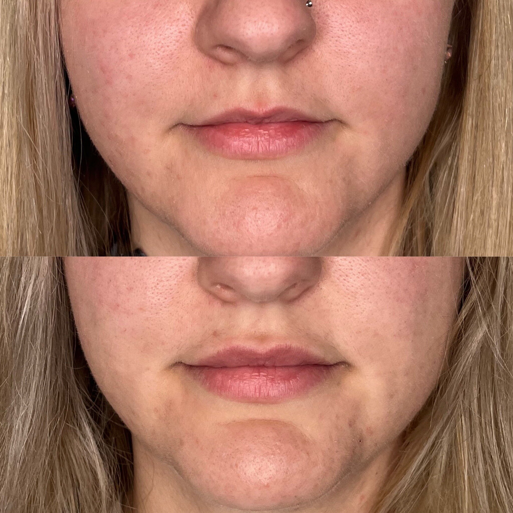 HEALED LIPS! Most of the time, we are posting lips fresh off the needle, so here is a beautiful soft lip enhancement healed at the 6 week mark! She came in to us wanting more balance, and to &quot;lift her upper lip more&quot;. 

Notice her upper lip