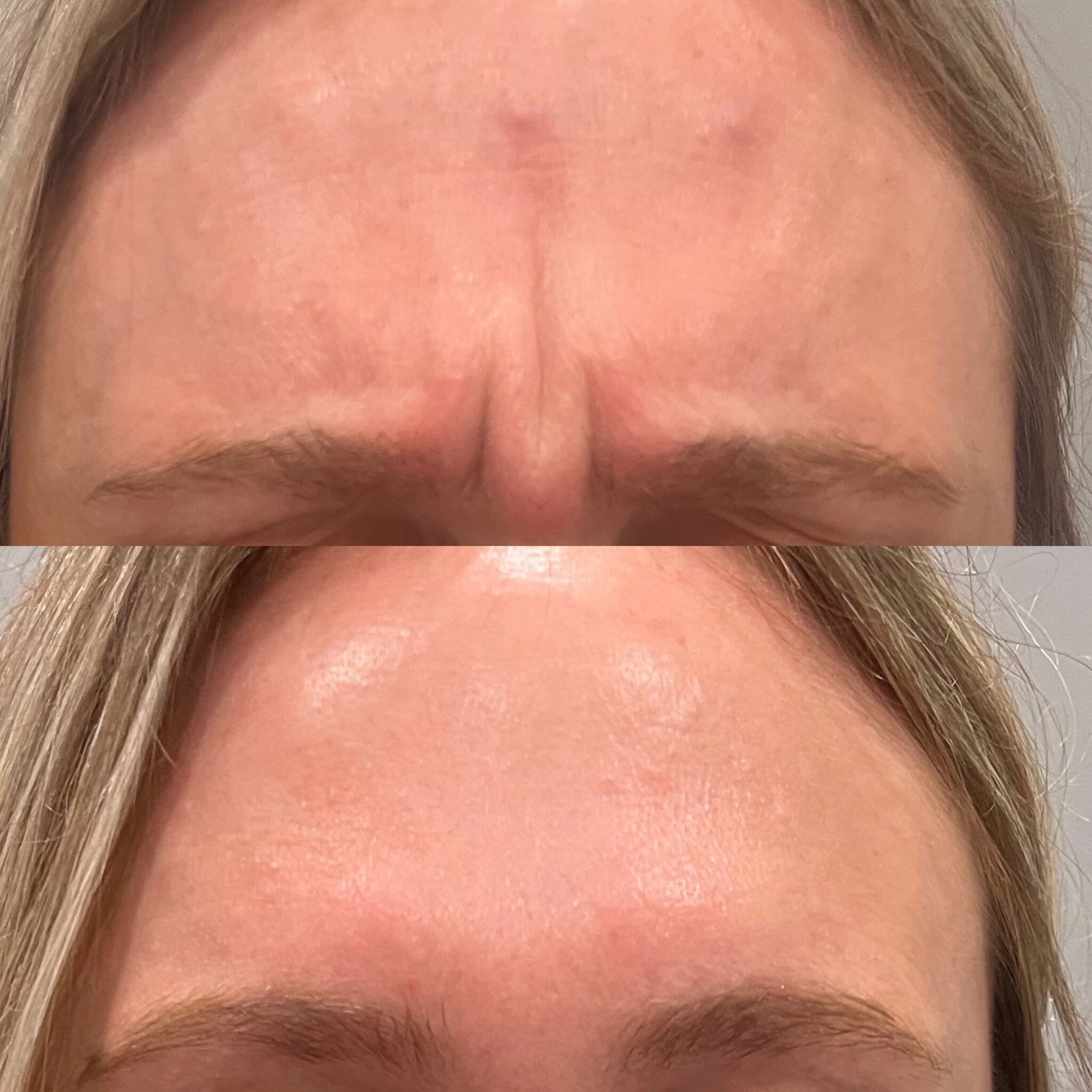 SLB is giving you smooth foreheads and no frowns in all of Temiskaming Shores &amp; Collingwood! 

This beautiful client came in wanting some refreshing treatment and was thrilled with her results! 

Interested in what your dosing/cost would be for y