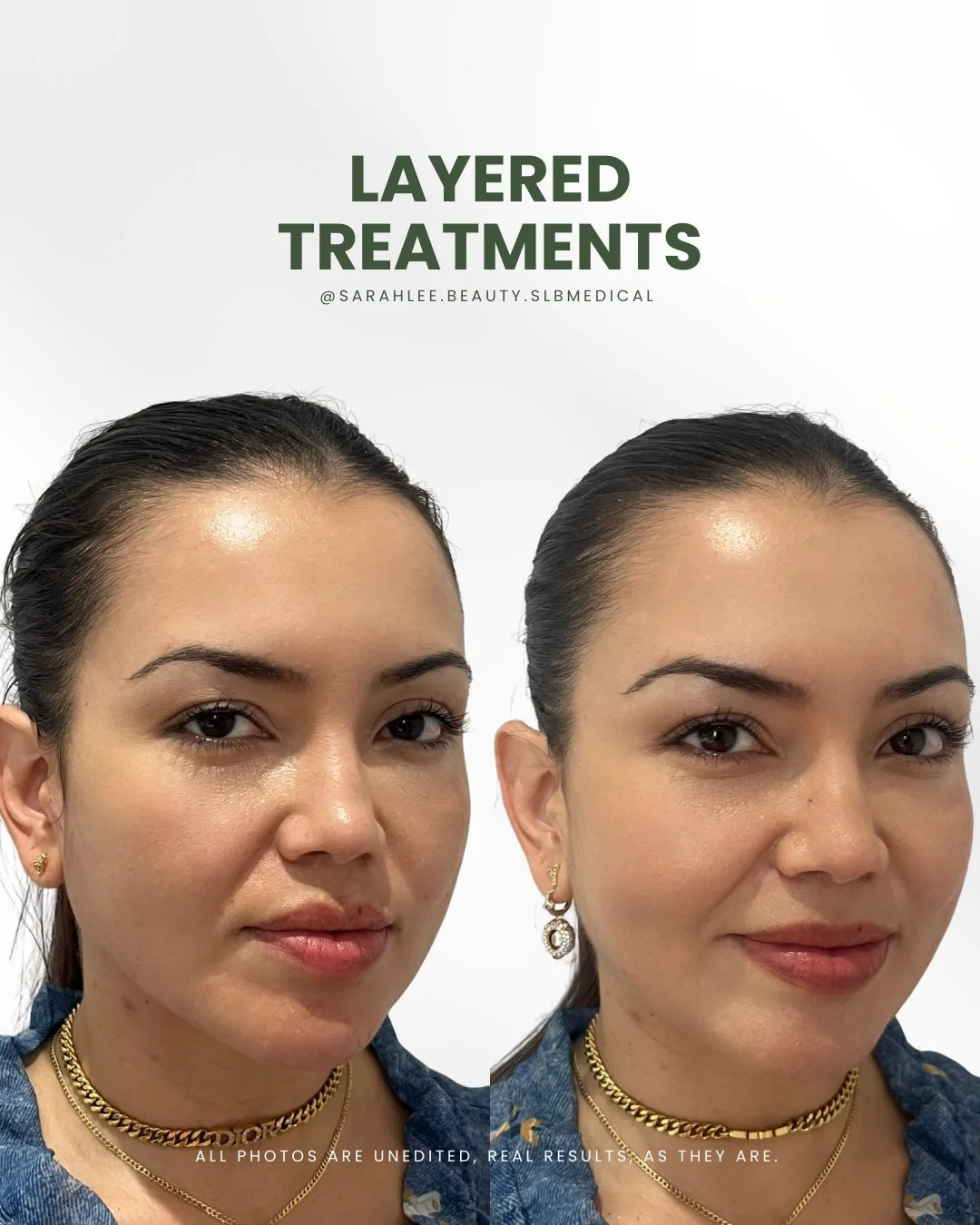 ✨ This beautiful client has been with us for three years now, and her results are a perfect reminder that it&rsquo;s never just a &ldquo;one-appointment fix.&rdquo; 

We&rsquo;ve done little sprinkles of treatments along the way, 

👉🏻two sessions o