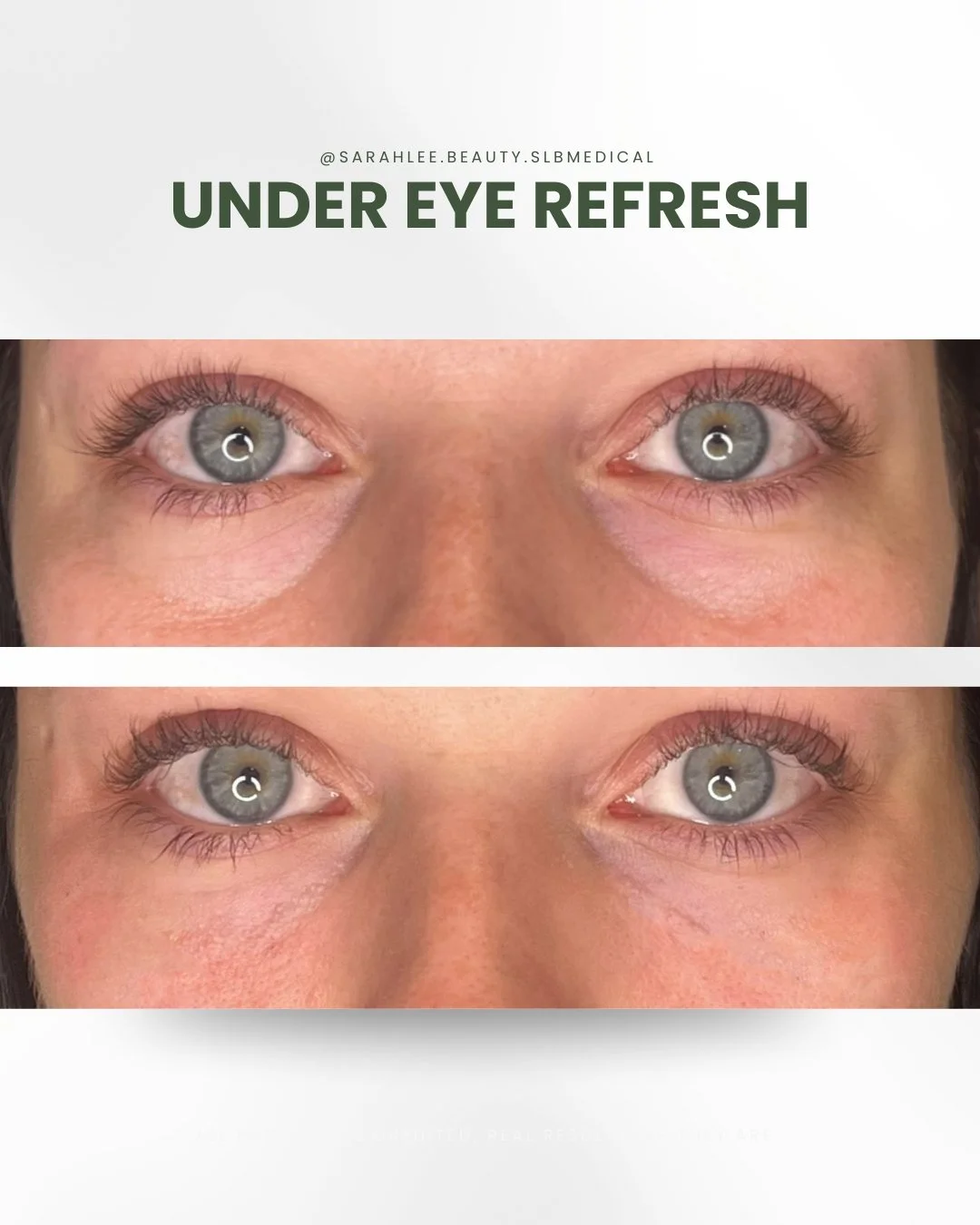 Most injectors treat from the inner corner to the centre of the under-eye, and stop there. But that’s often not where the real problem lies.
Our Under Eye Refresh goes beyond the basics. It’s a customized combo therapy that targets what