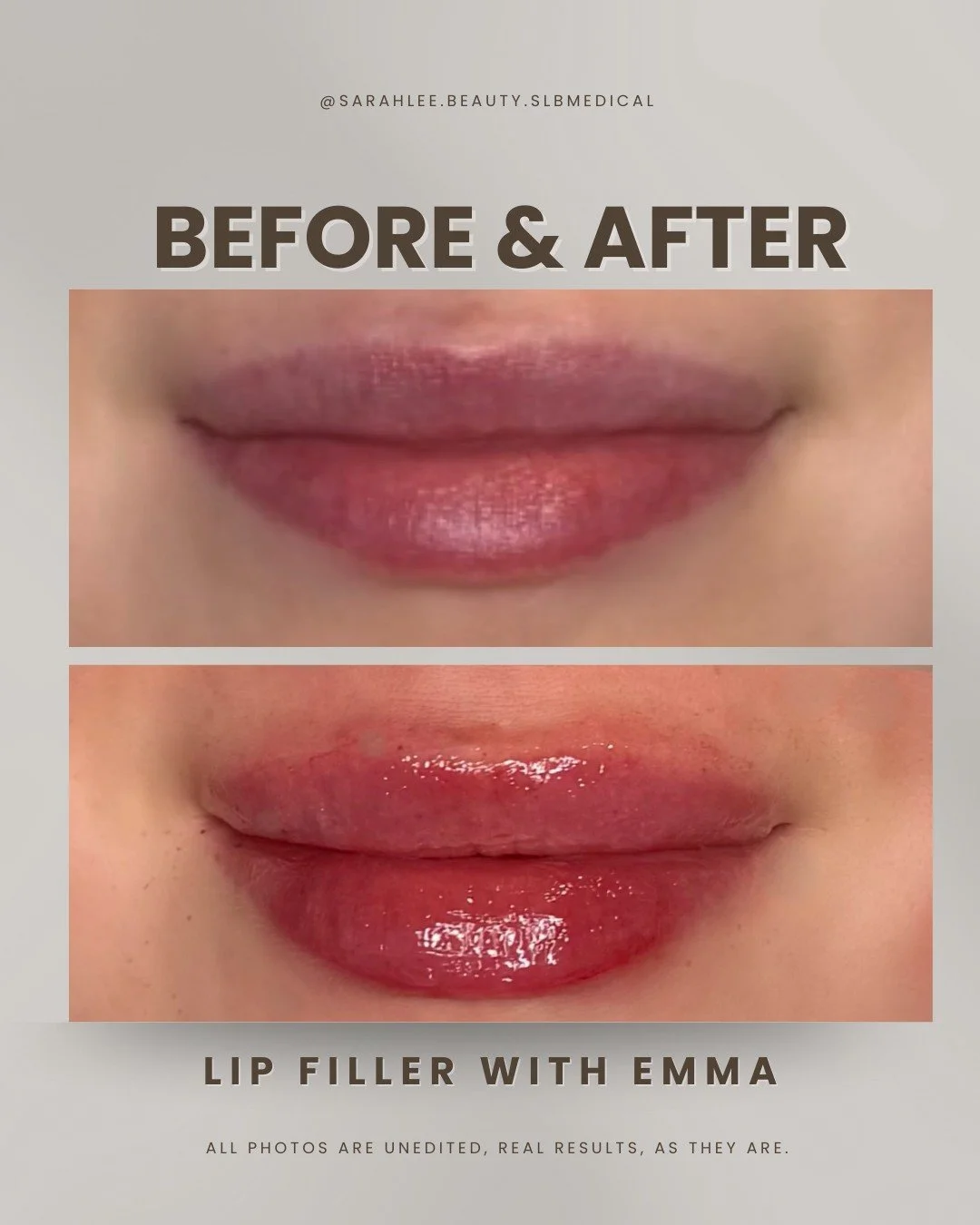 This client wanted a little extra volume, shape refinement, and hydration, all while keeping their natural look 👄✨

With Emma, every detail is thoughtfully considered to create lips that enhance without overpowering your features. Whether it&rsquo;s