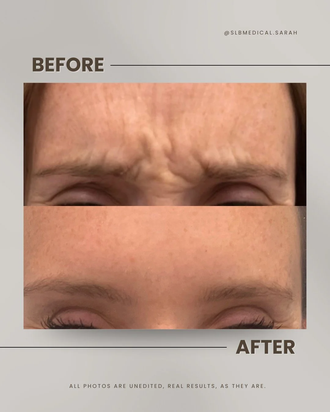 Forehead lines aren&rsquo;t always about age.
Often, they&rsquo;re simply the result of strong, repetitive muscle movement over time.

Every time we raise our brows, the forehead muscles contract. Eventually, those repeated movements can begin to lea