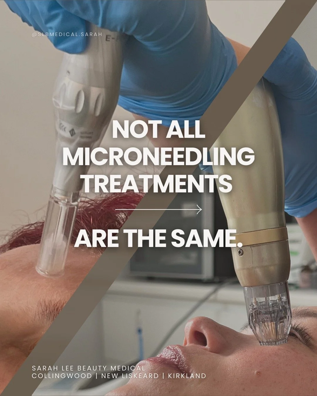 Not all microneedling treatments are created equal.

Traditional microneedling focuses on stimulating surface-level collagen. While helpful for improving texture, newer technologies can work deeper with within the skin.

RF microneedling combines tin
