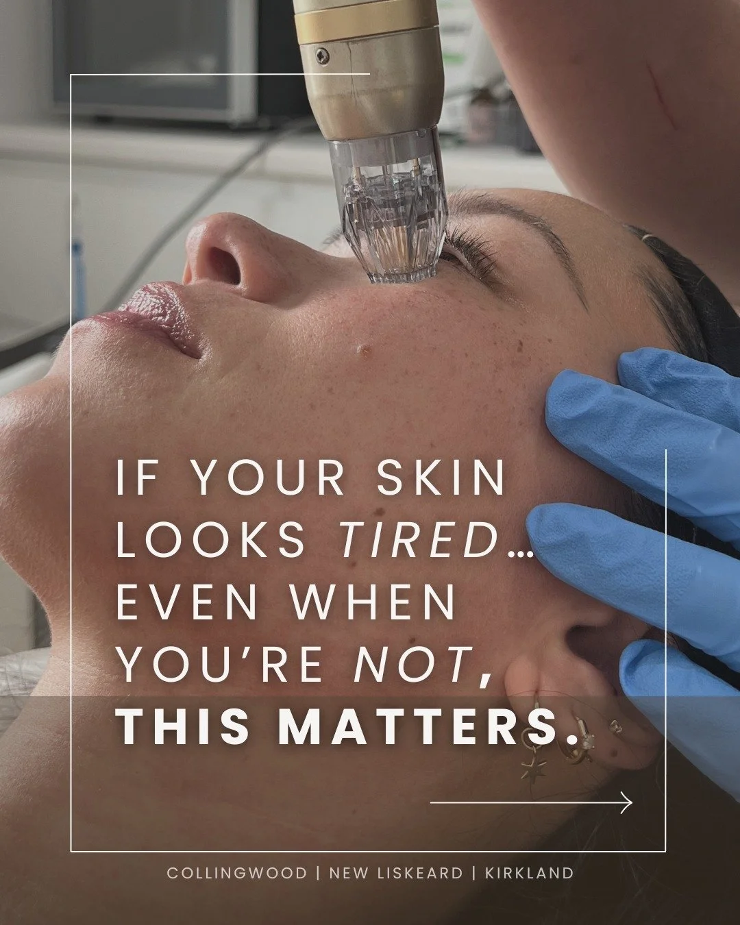 If your skin looks tired&hellip; even when you&rsquo;re not, this matters.
Sometimes it&rsquo;s not about what you&rsquo;re putting on your skin. It&rsquo;s about what&rsquo;s changing within it.

As collagen slows and skin structure begins to shift,