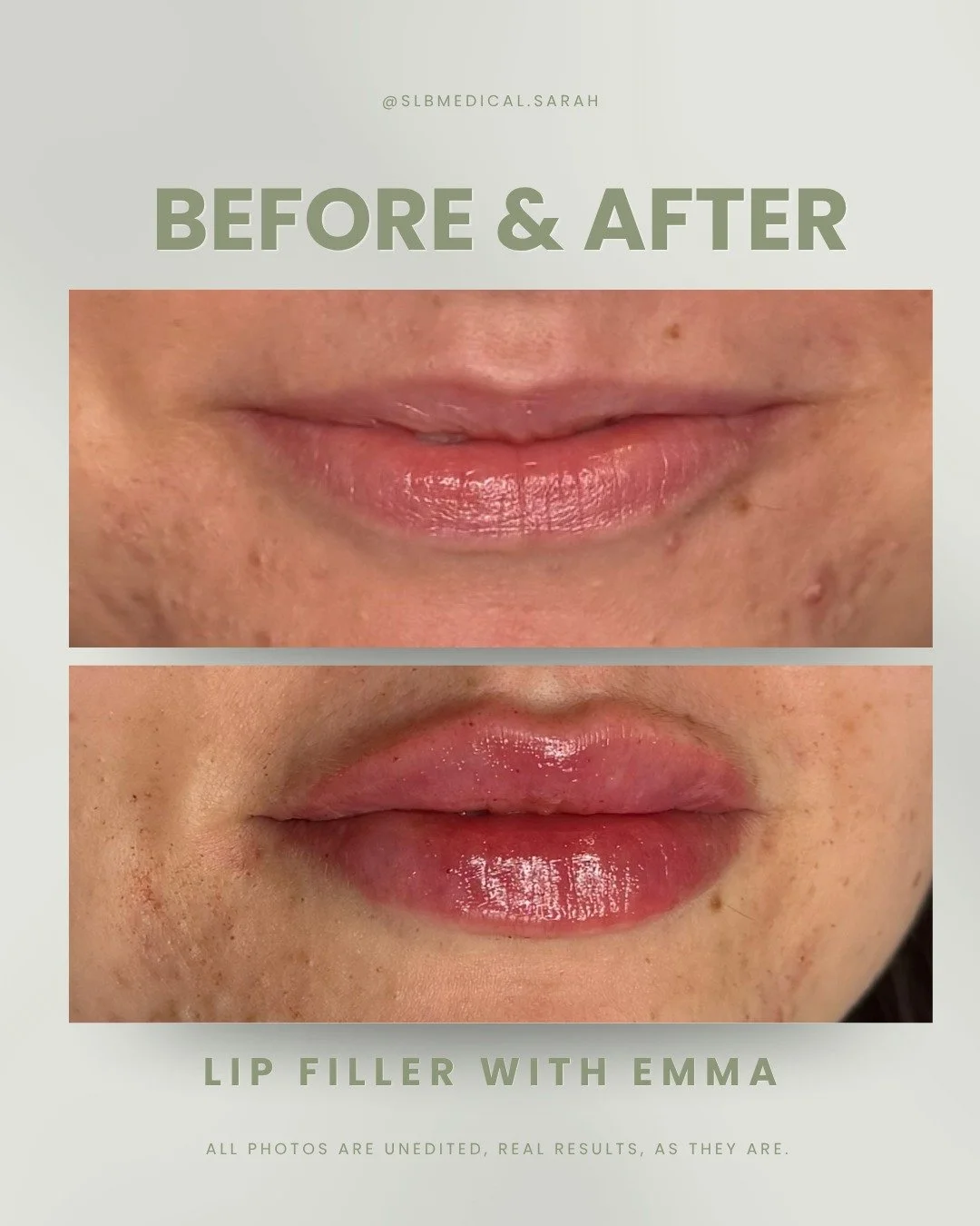 A little lip refresh 👄✨

This before &amp; after is such a beautiful example of how subtle tweaks can make such a difference 🤍

Every lip appointment starts with a conversation. About your features, your goals, and the kind of result you actually w