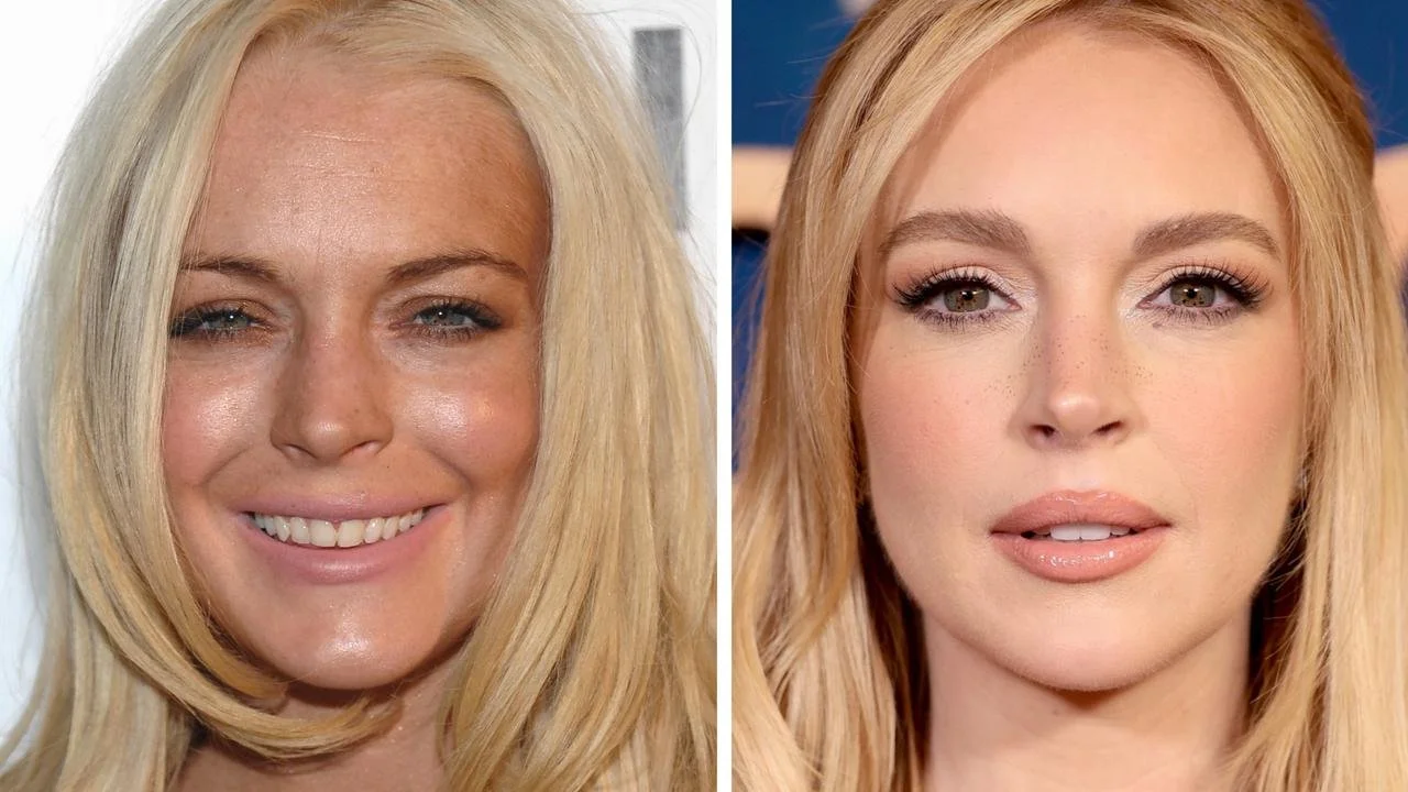 What we think of the "Lindsay Lohan Glow-Up": Why Sculptra and RF Microneedling Are the Real MVPs of Natural Aging