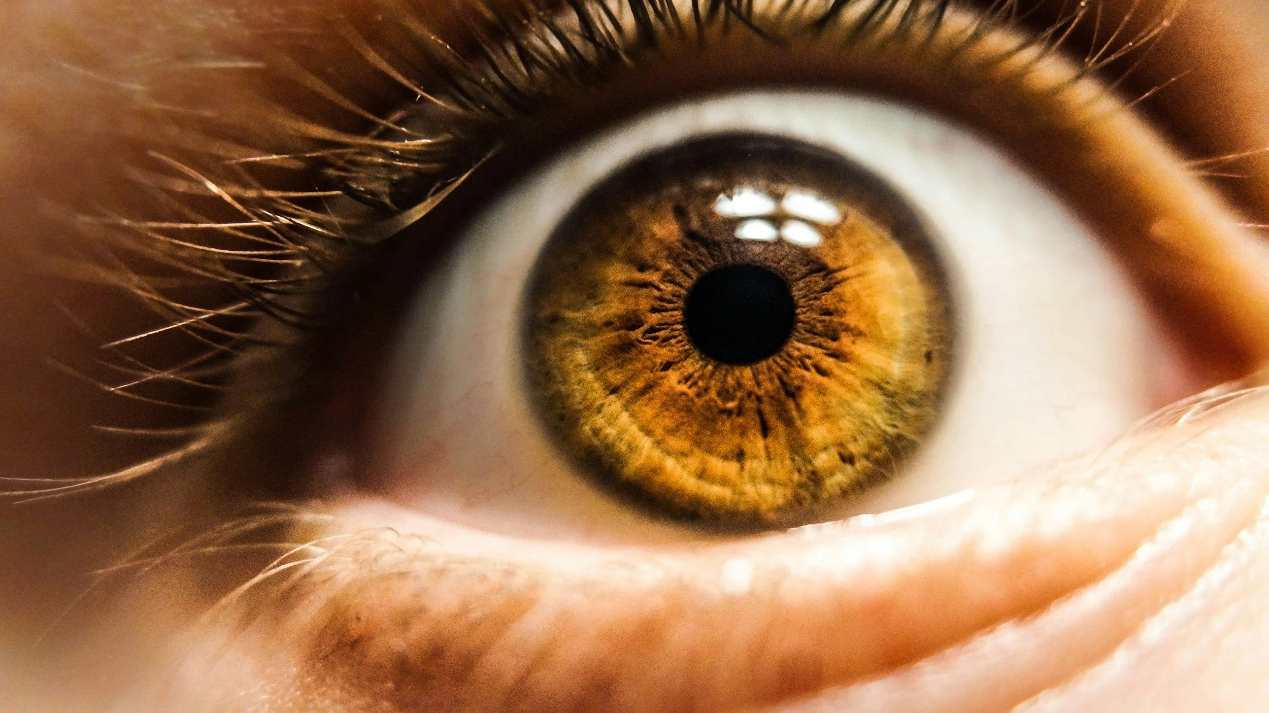 Mixed-biliary iris with contraction furrows and pigments
