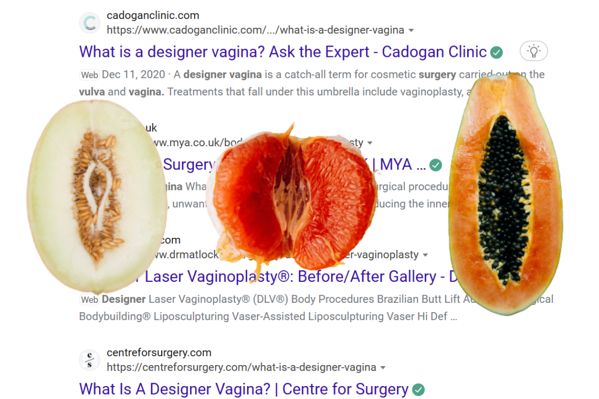 Labiaplasty, Vaginoplasty and Designer Vagina