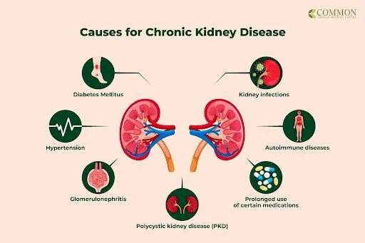 Causes Of Chronic Kidney Disease Chronic Kidney Disease A causes-of-chronic-kidney-disease-chronic-kidney-disease-a