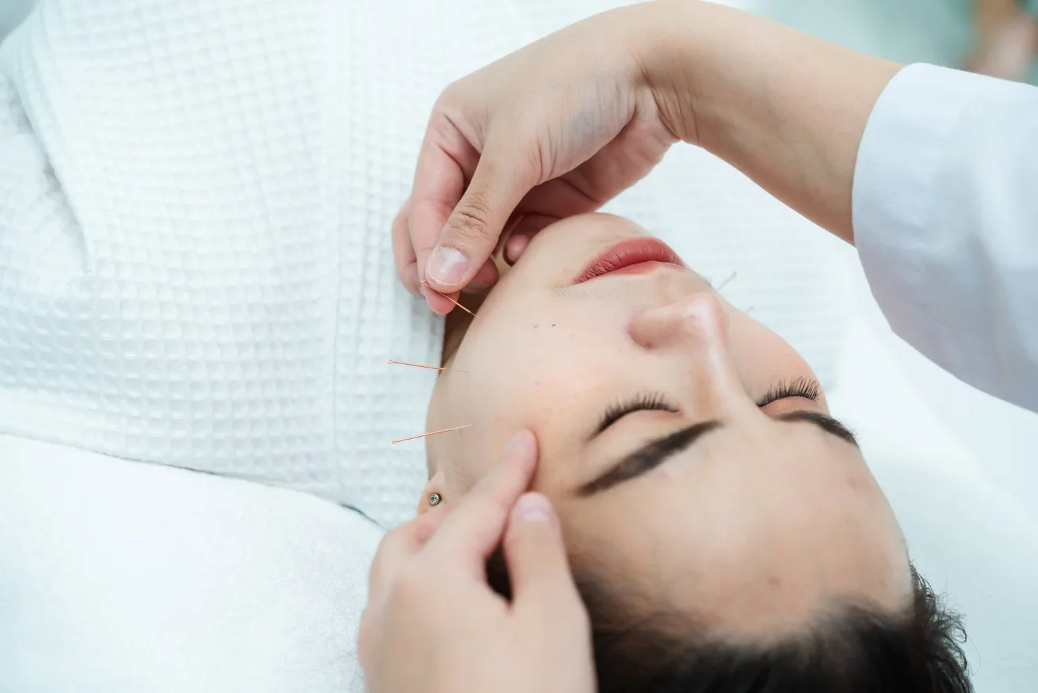 Woman receiving facial acupuncture treatment while resting comfortably with eyes closed, illustrating TCM acupuncture as part of a personalised approach to relaxation, stress management, and sleep support.