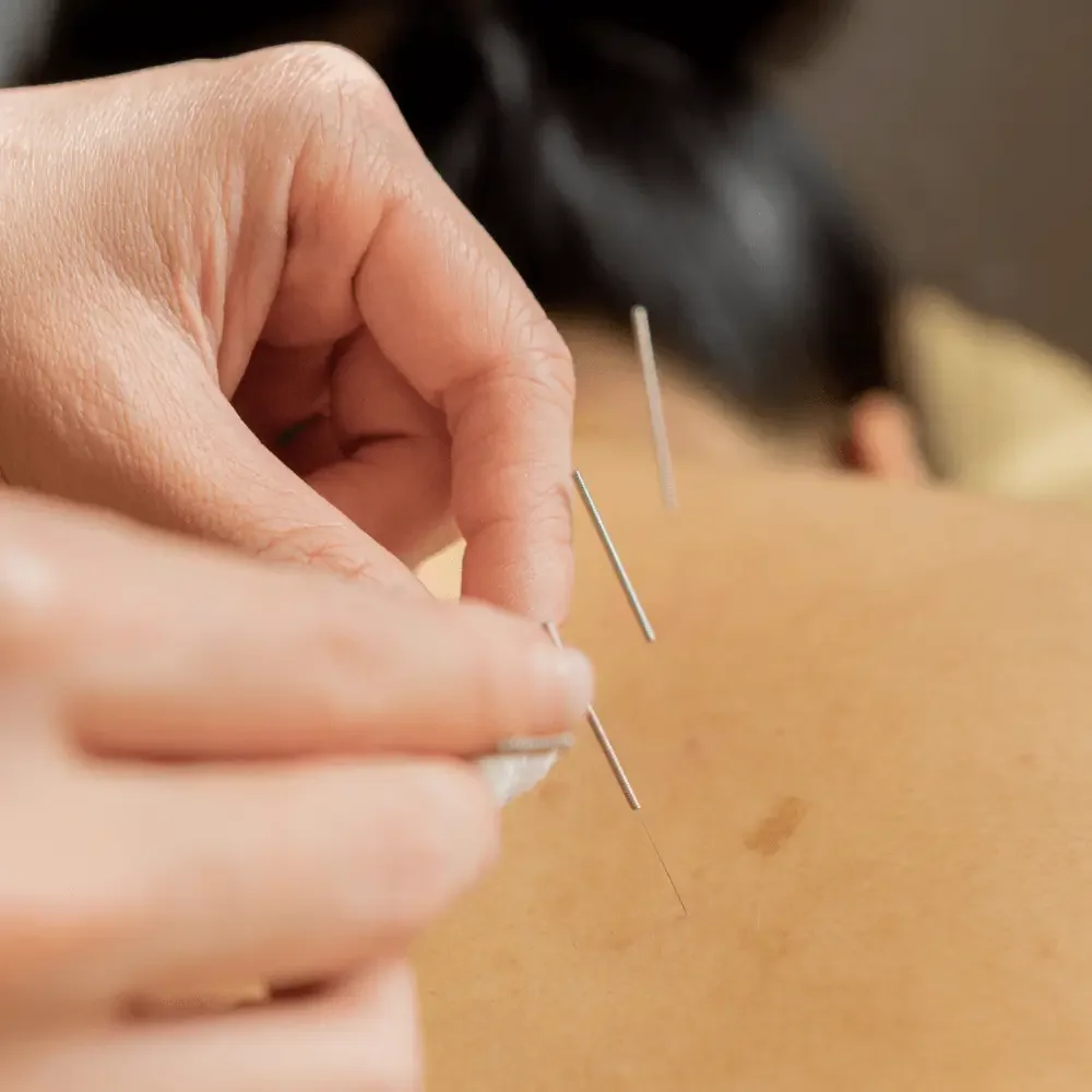 backed acupuncture.webp