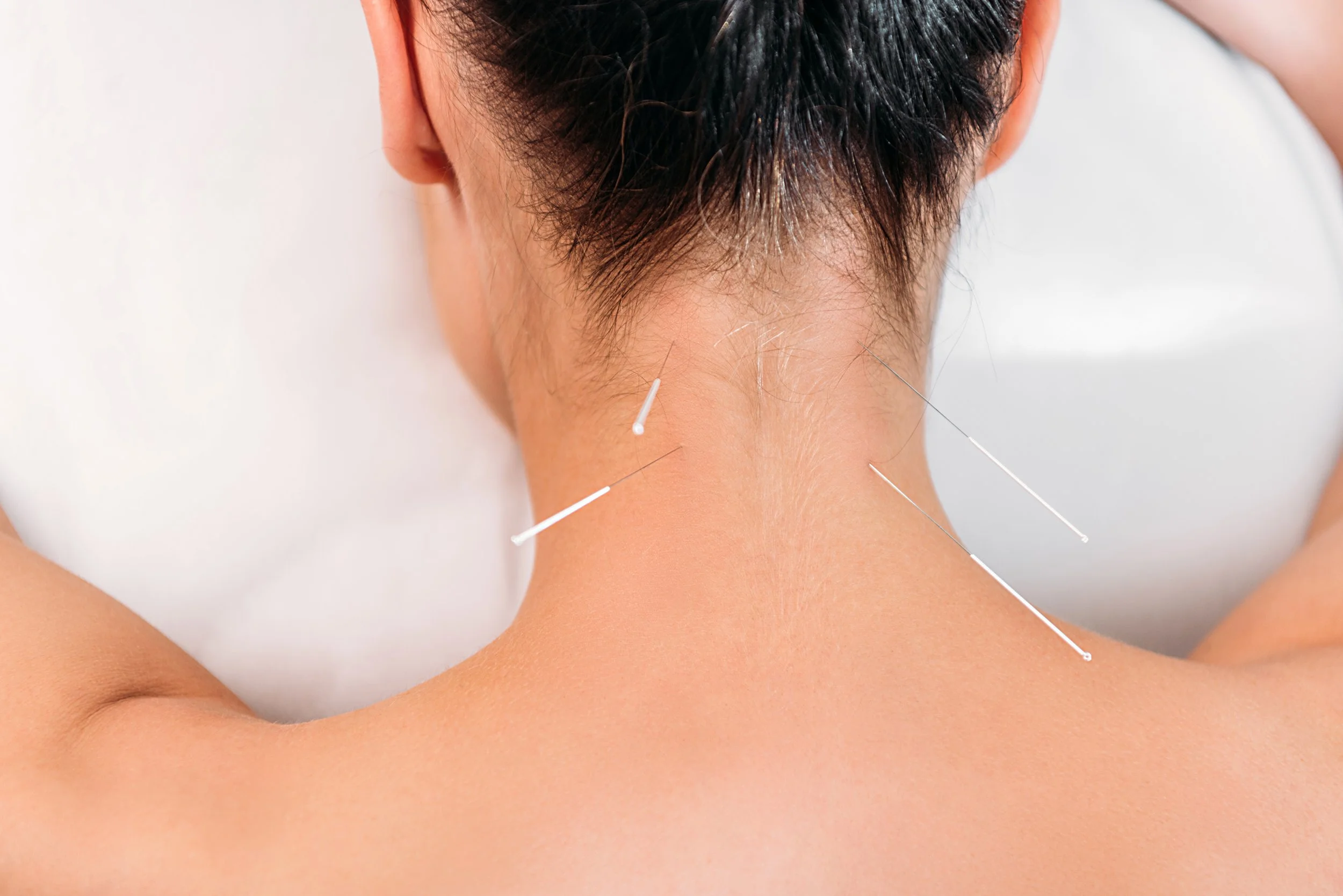 Close-up of acupuncture needles placed along the neck area during a TCM acupuncture treatment session.