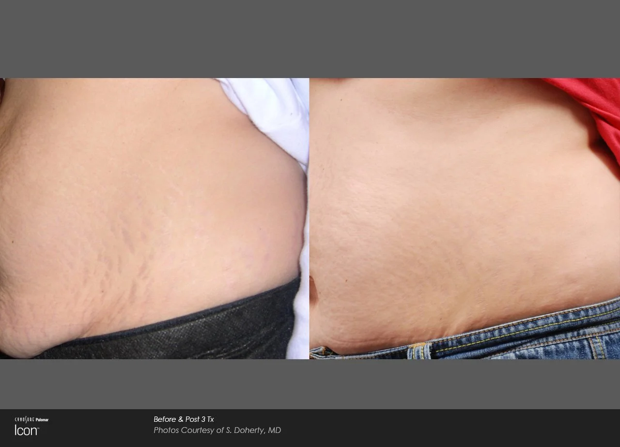 stretch mark removal