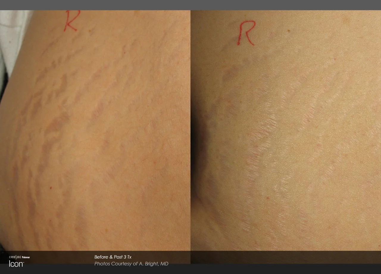 stretch mark removal
