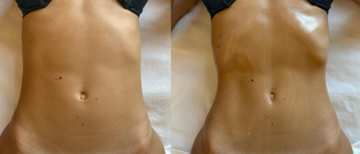 lymphatic-drainage-massage-wadebridge