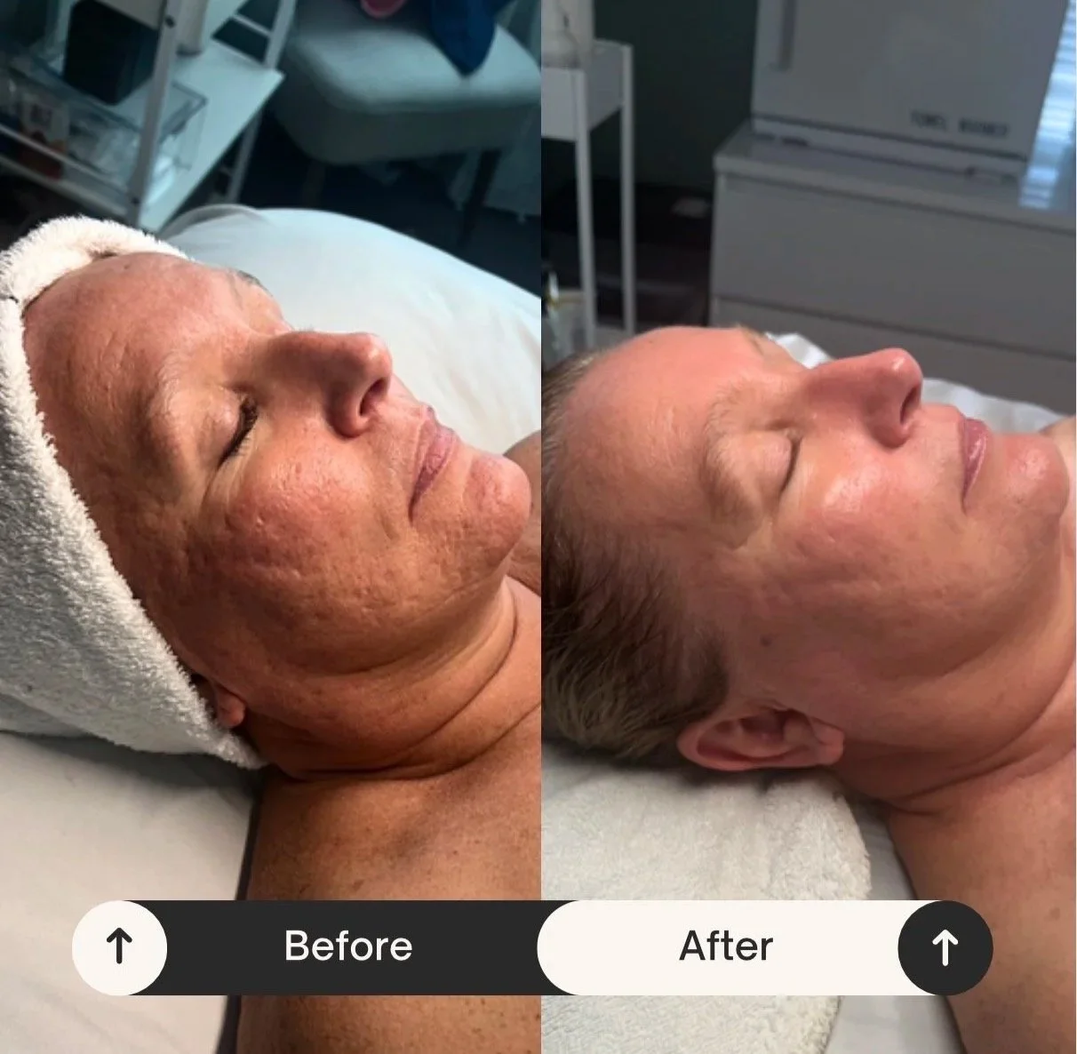 Microneedling & Chemical Peels