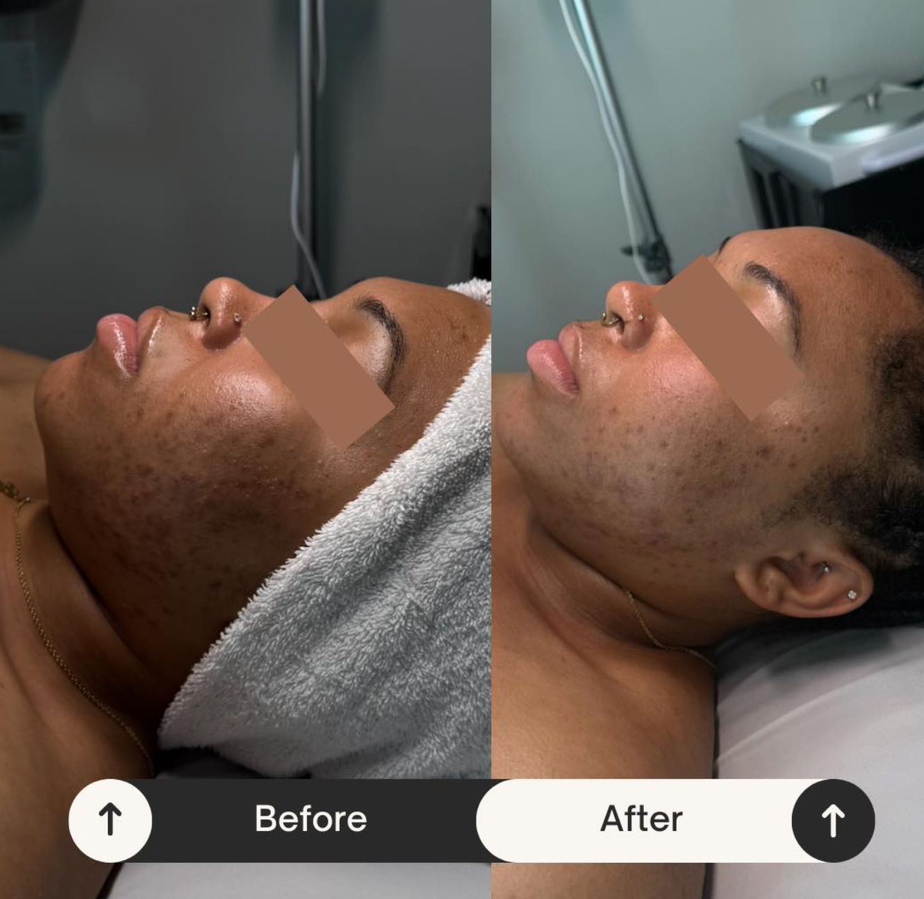 2 months  of Level 1 Peels