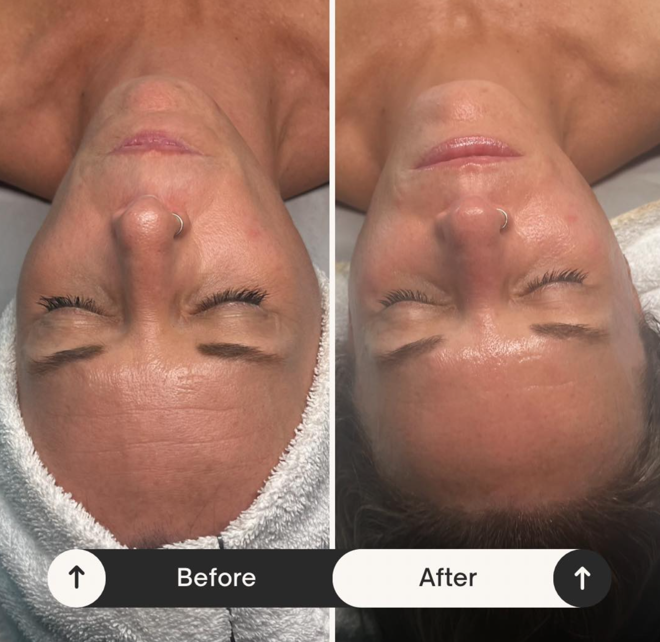 Hybrid Peel