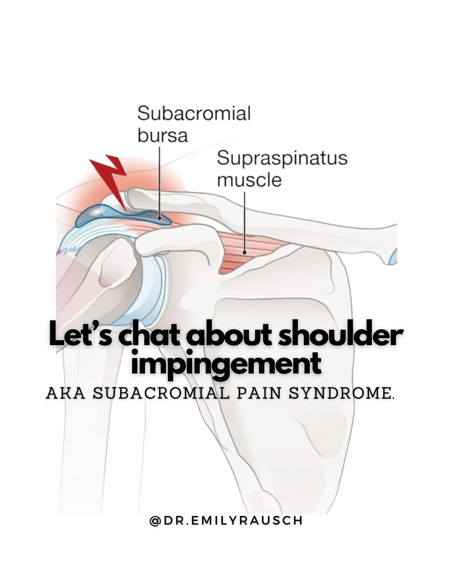 Reminder that I'm running an online course starting May 19th to help you learn how to not f*ck up your shoulders pole dancing. Link in bio to sign up. 

Shoulder impingement is one of the more common injuries I help pole dancers rehab. 

This conditi