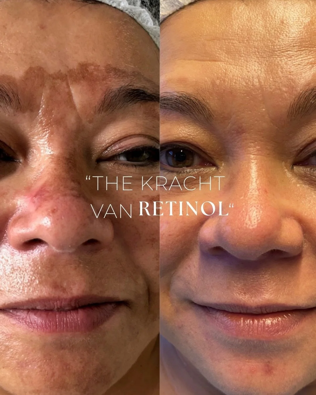 𝗗𝗘 𝗞𝗥𝗔𝗖𝗛𝗧 𝗩𝗔𝗡 𝗥𝗘𝗧𝗜𝗡𝗢𝗟.
Vervaagt pigment. Verfijnt textuur. Herstelt balans.