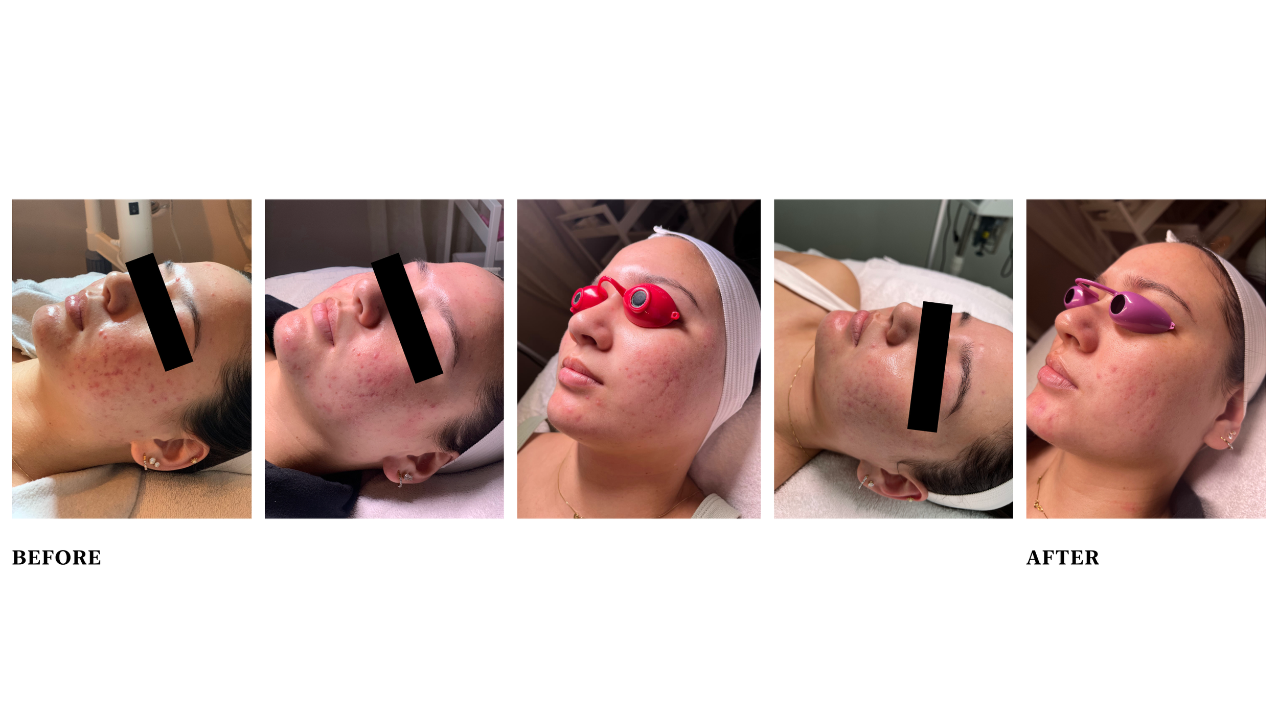  Condition: inflamed acne with post inflammatory pigmentation  Treatment: Celluma LED, and PCA peels. Consistent home care&nbsp;with customized PCA products and Living Libations best skin ever. 