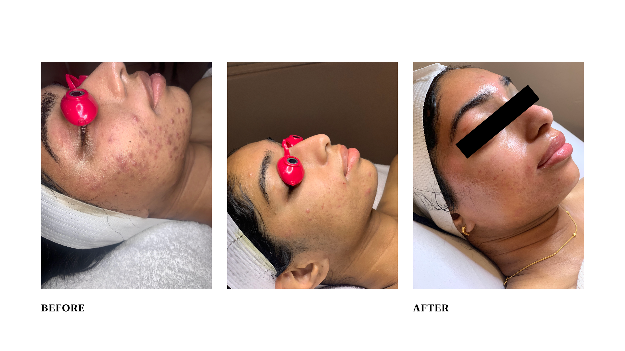  Condition: cystic acne and post inflammatory pigmentation  Treatment: combination of facials using Celluma LED and 2 PCA peels. Client consistently used customized PCA skincare at home in between treatments. 
