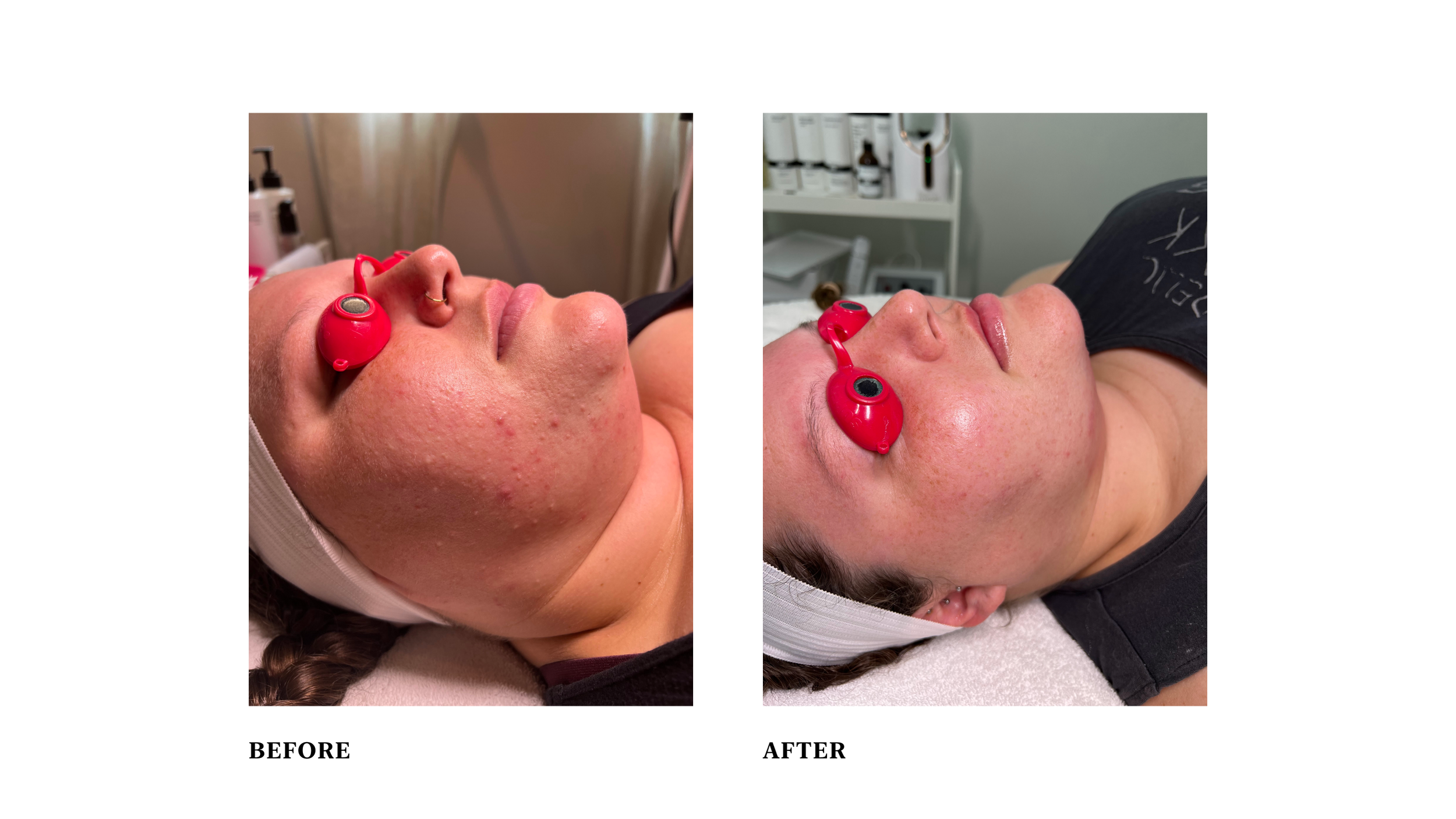  Condition: inflammation, oily, hyperkeratotic build-up  Treatment: customized facials, peels, and consistent home regimen with PCA products 