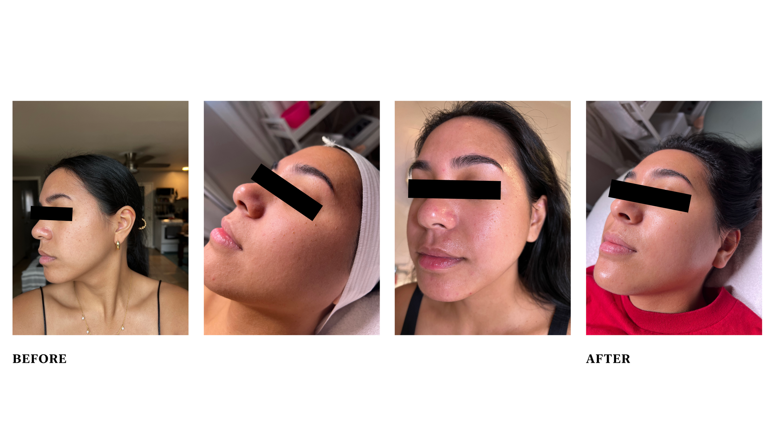  Condition: compromised barrier with congestion, sensitive, dehydrated  Treatment: started with PCA eczema kit to restore the barrier. Then we started with a series of PCA therapeutic treatment masks and peel. 