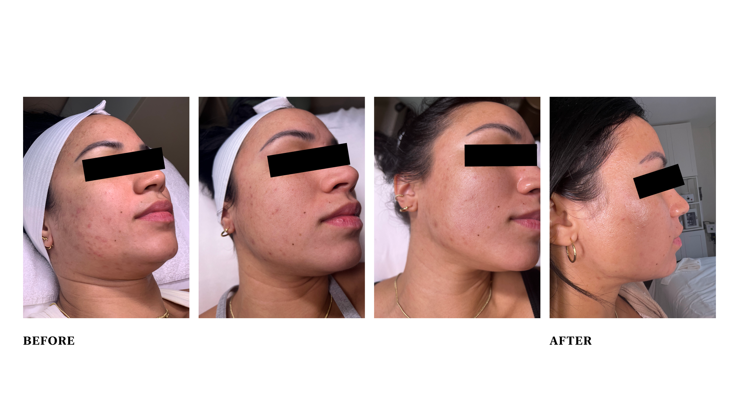  Condition: acne, dry, post-inflammatory pigmentation  Treatment: PCA peels, led treatments with therapeutic masking. Consistent home regimen with PCA and Living Libations. 