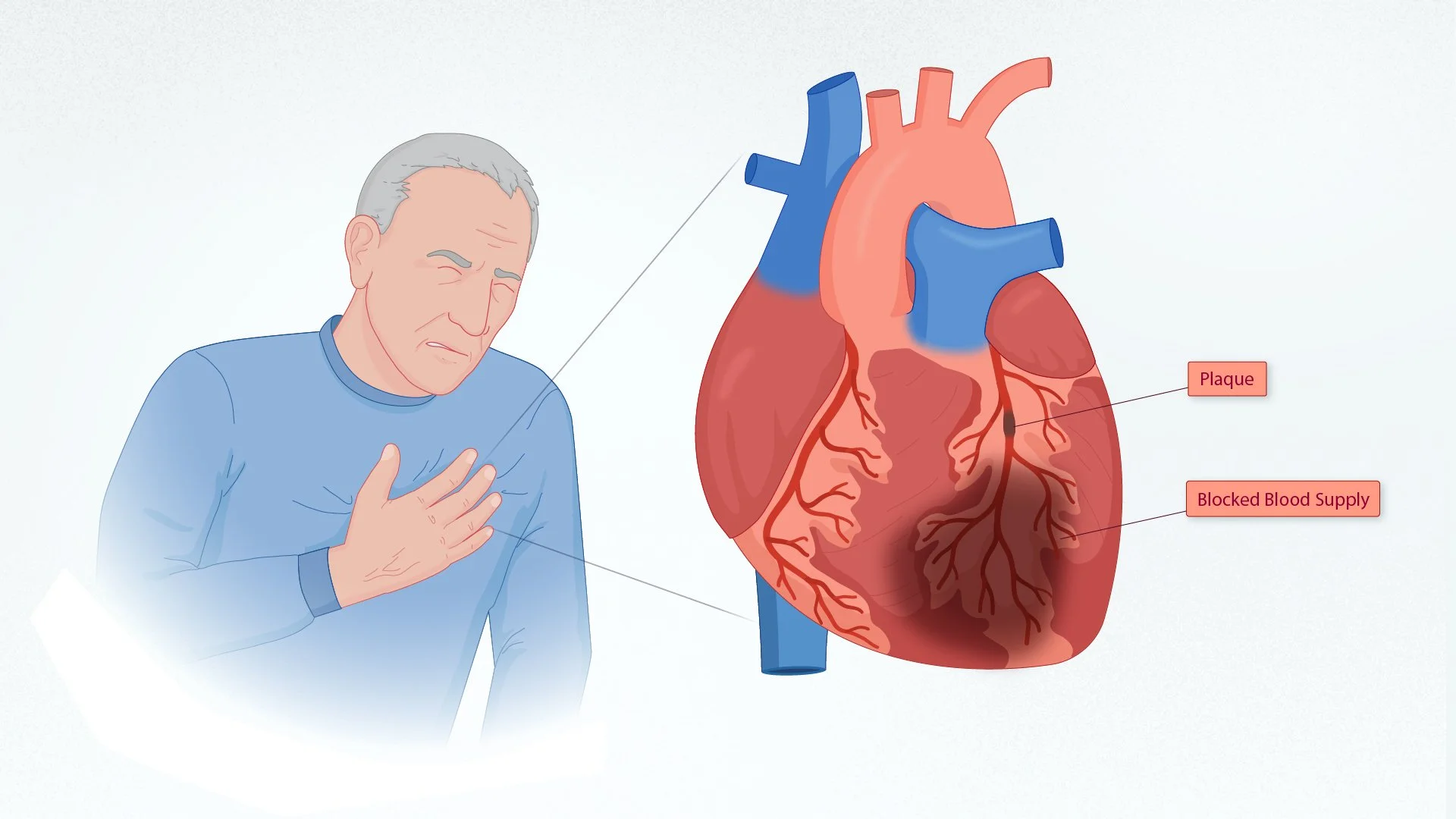 02_HeartAttack_and_Heart_fin.jpg