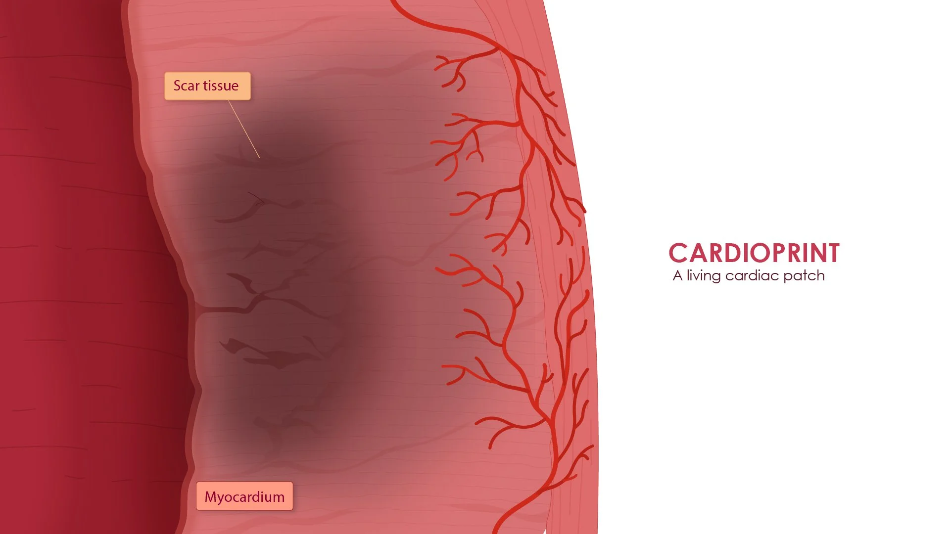 19_20_21_Myocardium_Patch_Integrates-03.jpg