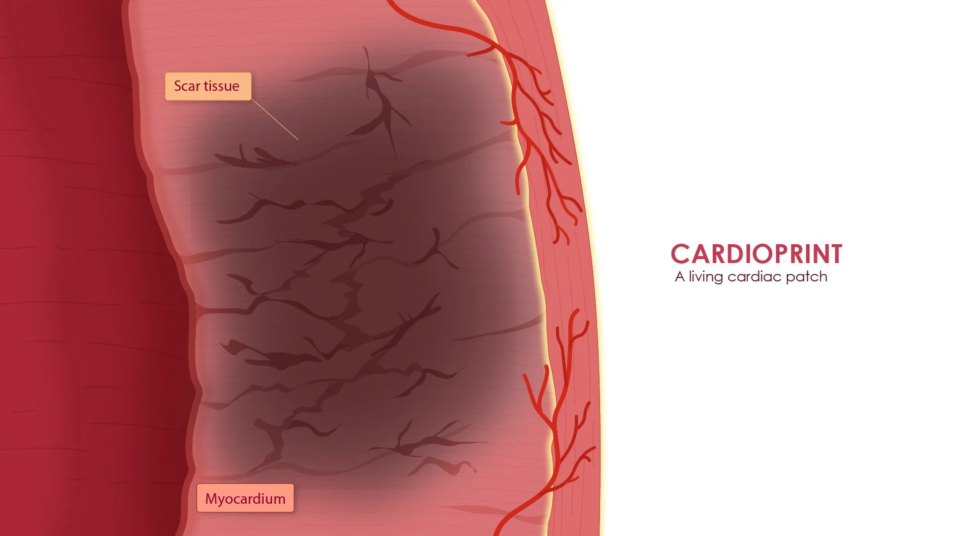 19_20_21_Myocardium_Patch_Integrates-01.jpg