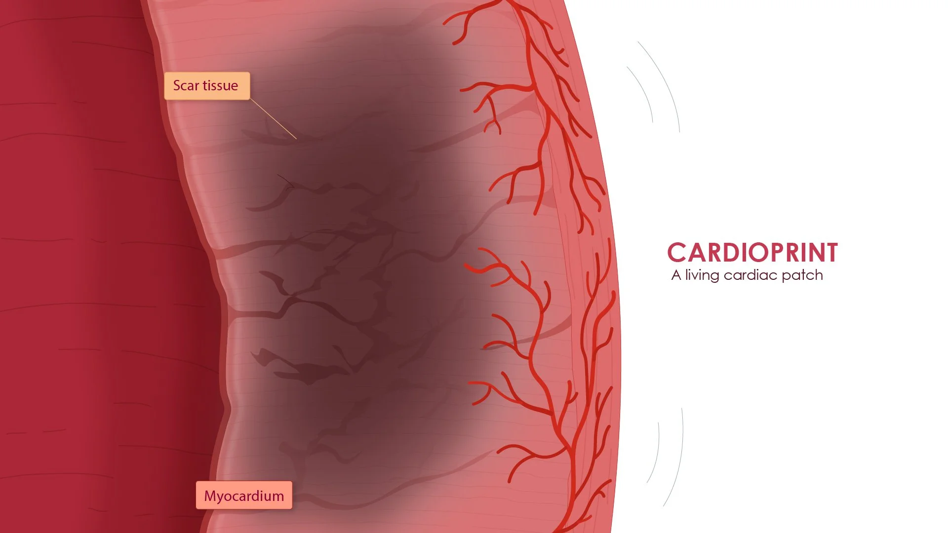 19_20_21_Myocardium_Patch_Integrates-02.jpg