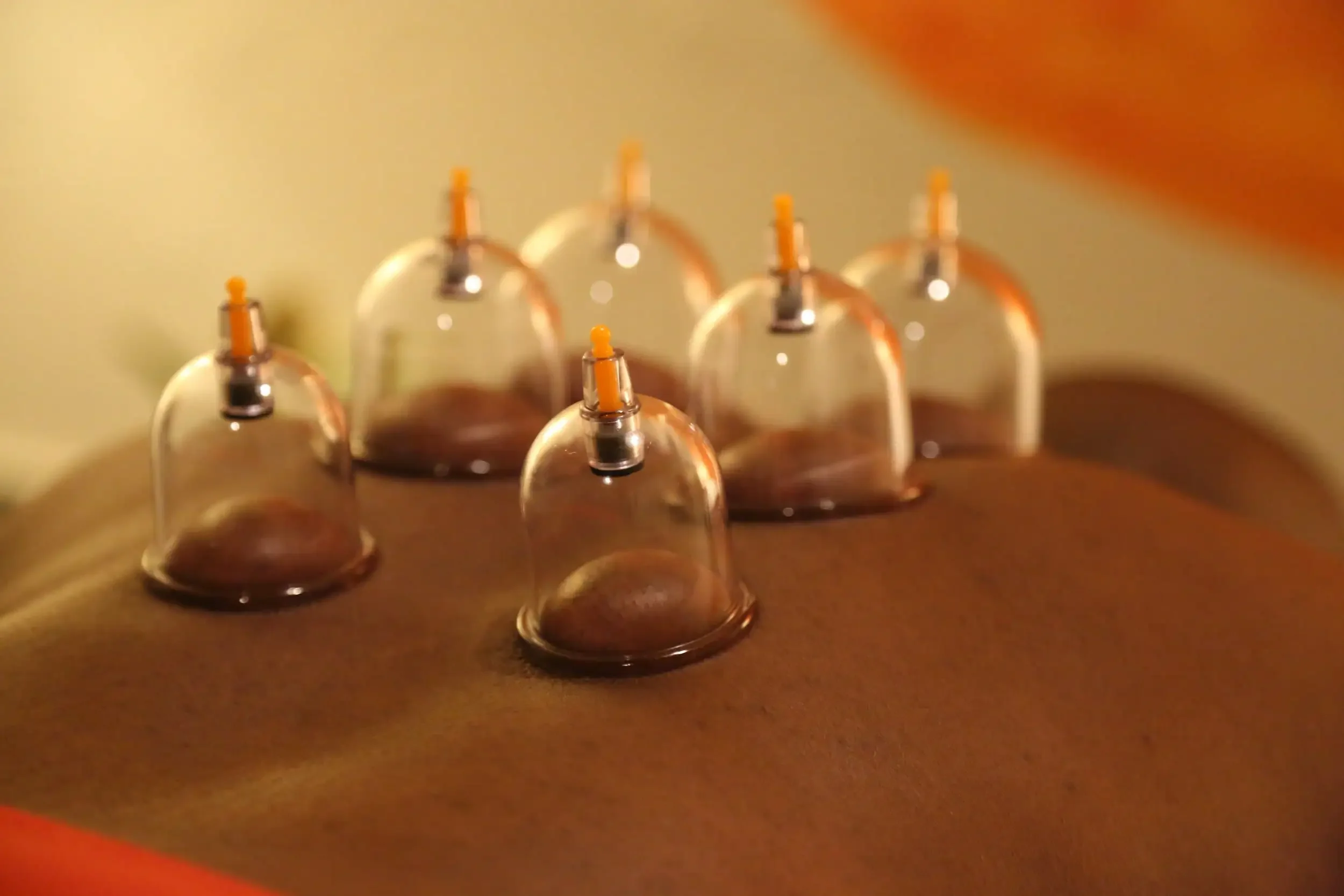 A massage therapy treatment with several small glass cups placed on a person's back to create suction.