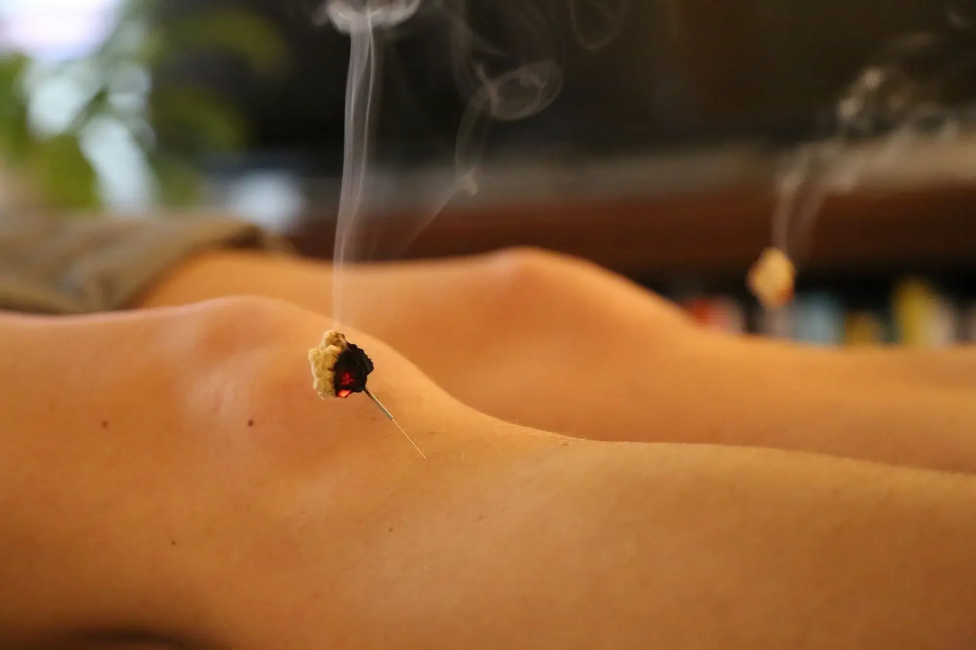 Close-up of a client receiving Moxa therapy