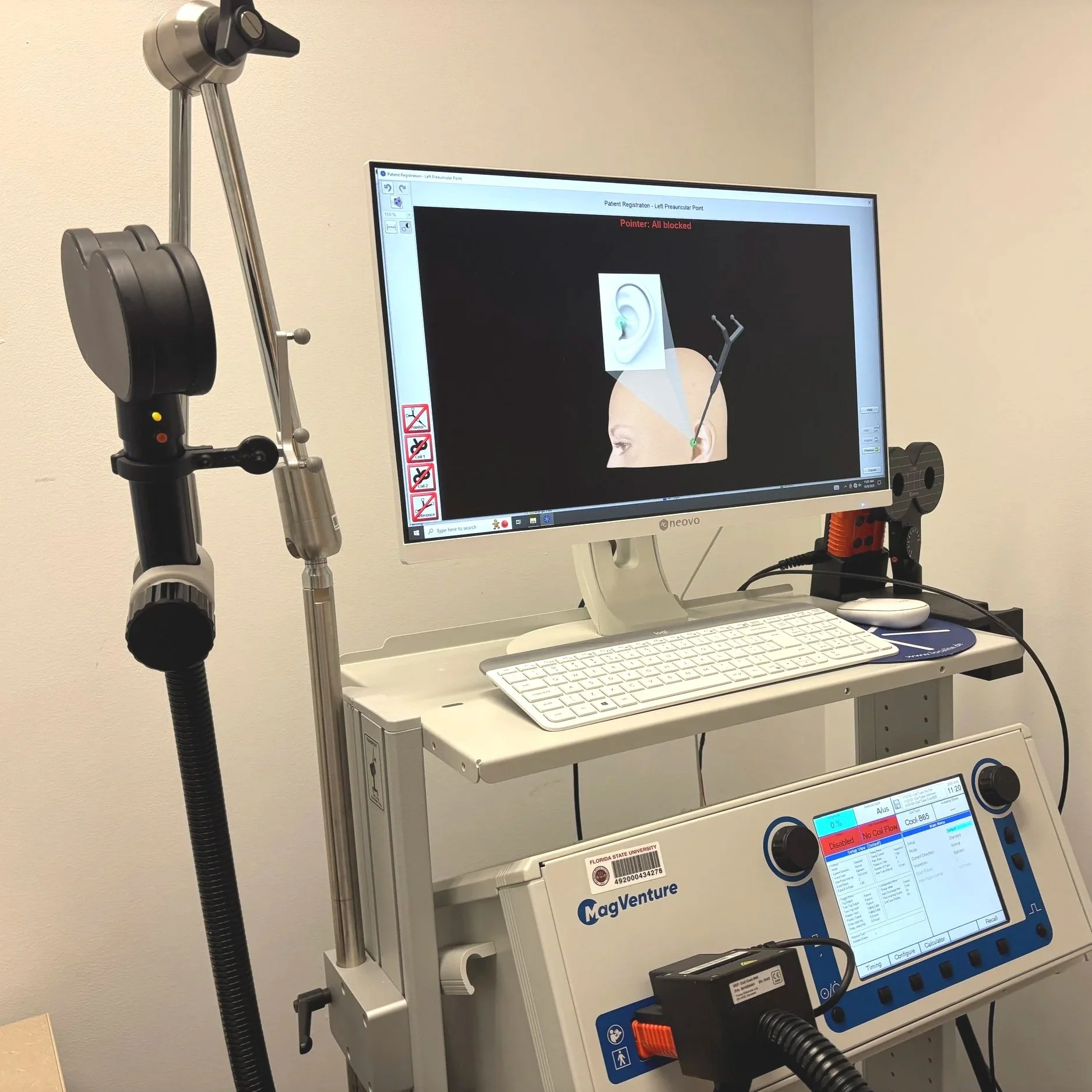 Localite Neuronavigation is used for personalized TMS stimulation targets.