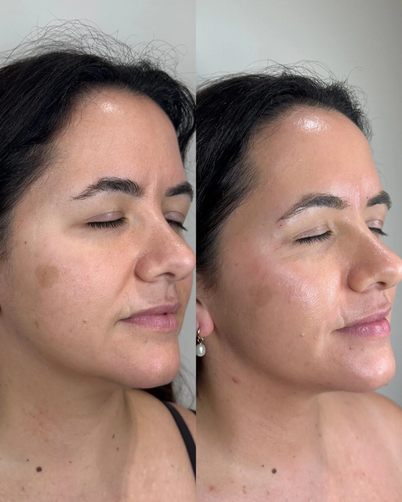 Before After just ONE Moxi treatment ✨

Moxi is a non-ablative fractionated laser designed to work below the surface of the skin to stimulate collagen, improve tone and texture, and address early signs of sun damage and aging, all with minimal downti