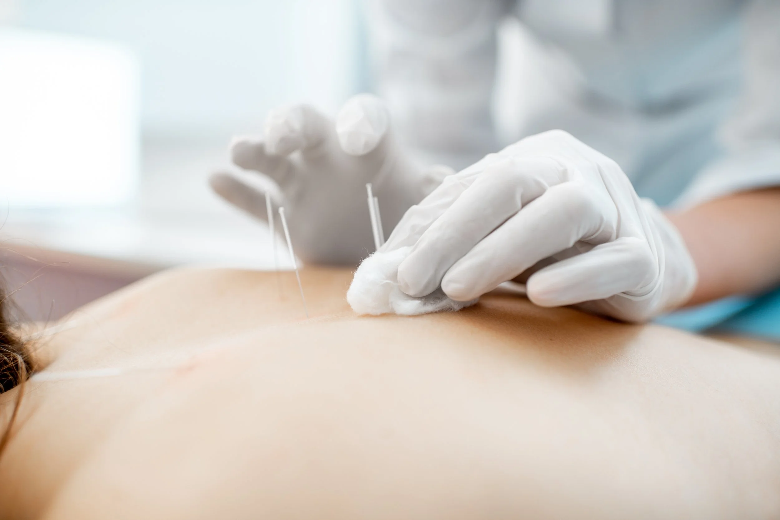 Dry Needling Near Me A Comprehensive Guide